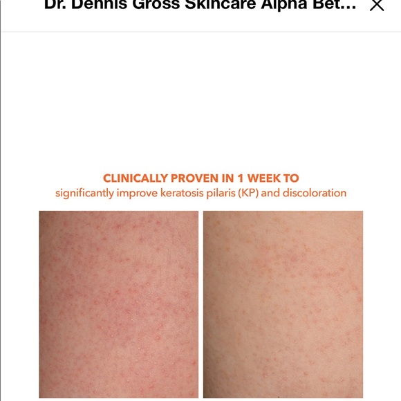 Dr Dennis Gross Alpha Beta Exfoliating Body Treatment Peel Scrub Pad Sealed. - Picture 3 of 4